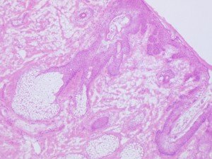 Frozen Section stained in H&E showing a Sebaceous Gland at the Epidermis of a Skin Biopsy 