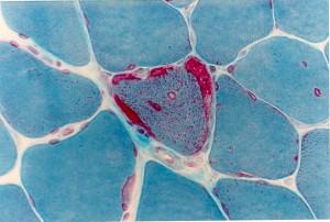 Muscle biopsy-Gomori Trichrome stain showing a ragged red fibre